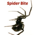 How to Treat a Brown Recluse Spider Bite - iSaveA2Z.com